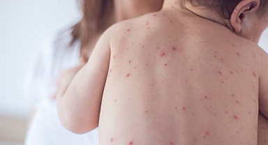 Alerjisi olanlara kızamık aşısı nasıl yapılmalı?