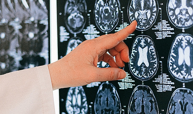 Uzmanlar uyarıyor! Yaşam tarzı alışkanlıkları Alzheimer riskini artırabilir